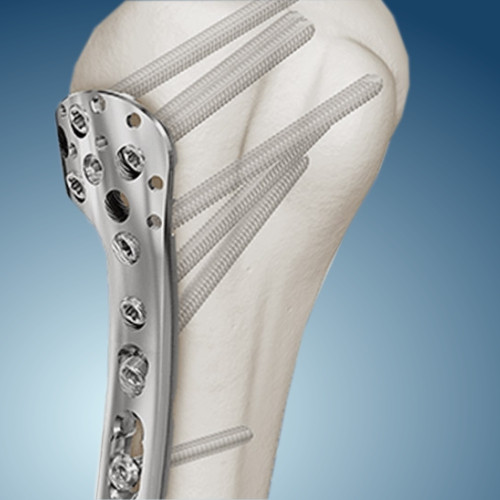 Накостный остеосинтез блокированными пластинами Москва - изображение 1