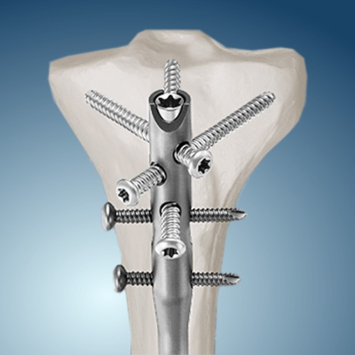 Интрамедуллярный остеосинтез Москва - изображение 1