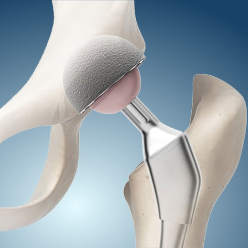 Эндопротезы тазобедренного сустава Москва - изображение 1