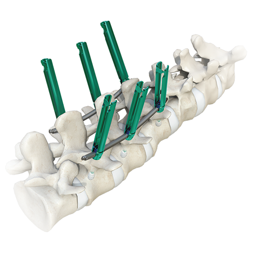 Имплантат MIS Plus Москва - изображение 1